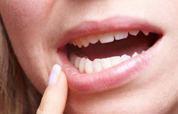 خطير : لا تتجاهلها .. ظهور هذه العلامتان في الفم تدلان على ارتفاع نسبة السكر في الدم بشكل كبير