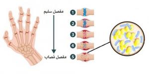 100 نوع من التهاب المفاصل