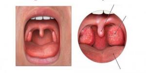 أعراض التهاب اللوزتين وطرق علاجها