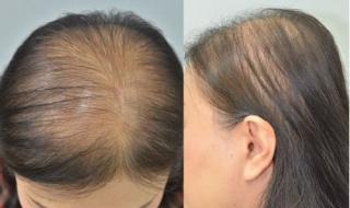 للرجال والنساء .. بهذه الطرق يمكنك علاج تساقط الشعر الوراثي