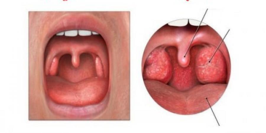 أعراض التهاب اللوزتين وطرق علاجها